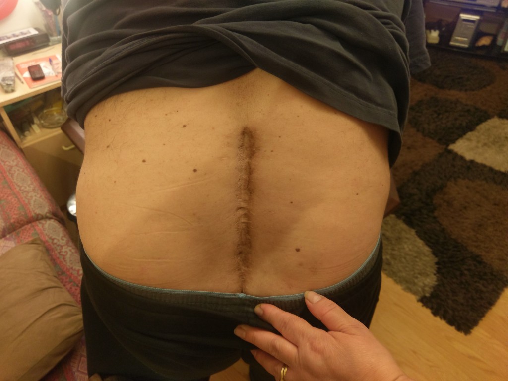 Soner Sabriler shows T-VINE the deep scar on his back following 7 major surgeries on his spine